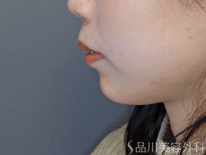 症例NO.72579のAFTER写真