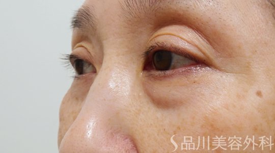 症例NO.69724のBEFORE写真