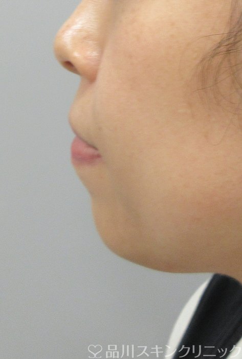 症例NO.74761のBEFORE写真