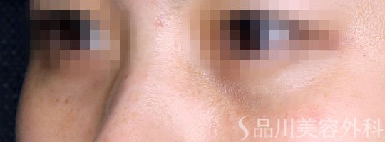 症例NO.66859のAFTER写真