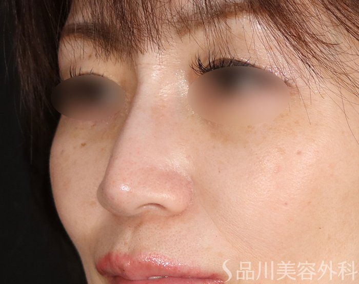 症例NO.73675のAFTER写真