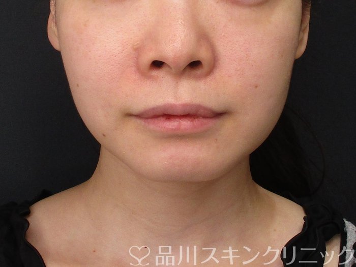 症例NO.70240のBEFORE写真