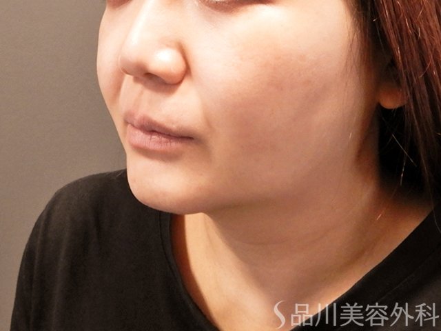 症例NO.69394のBEFORE写真