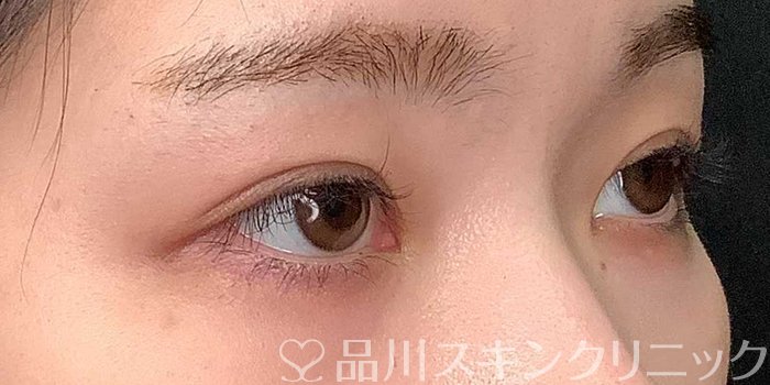 症例NO.69704のAFTER写真