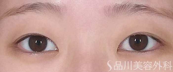 症例NO.66313のBEFORE写真