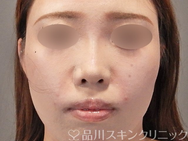 症例NO.75251のAFTER写真