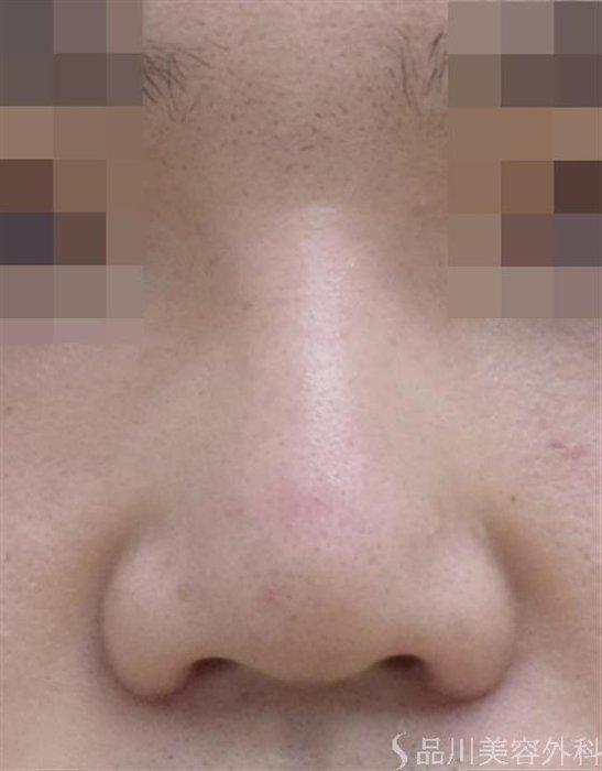 症例NO.47696のAFTER写真