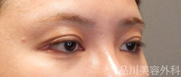 症例NO.67816のBEFORE写真