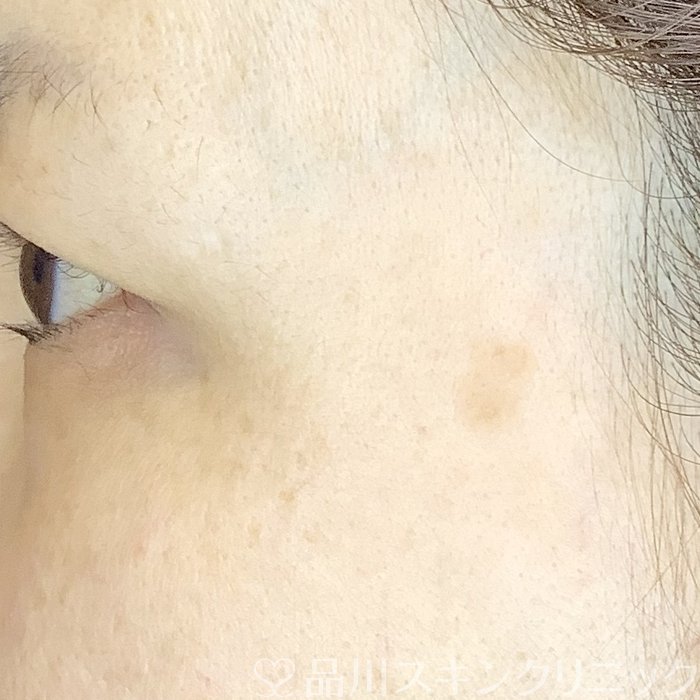 症例NO.65509のBEFORE写真
