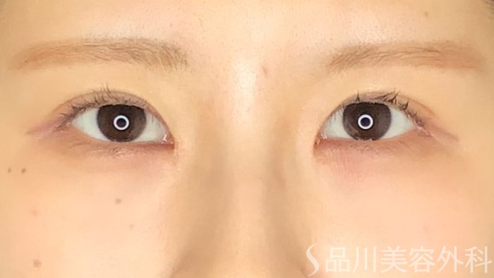 症例NO.69493のAFTER写真
