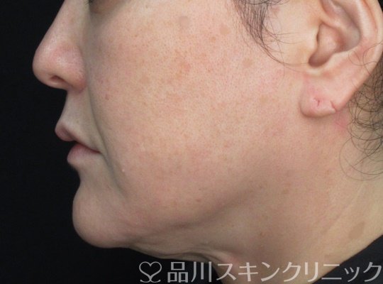 症例NO.71944のBEFORE写真