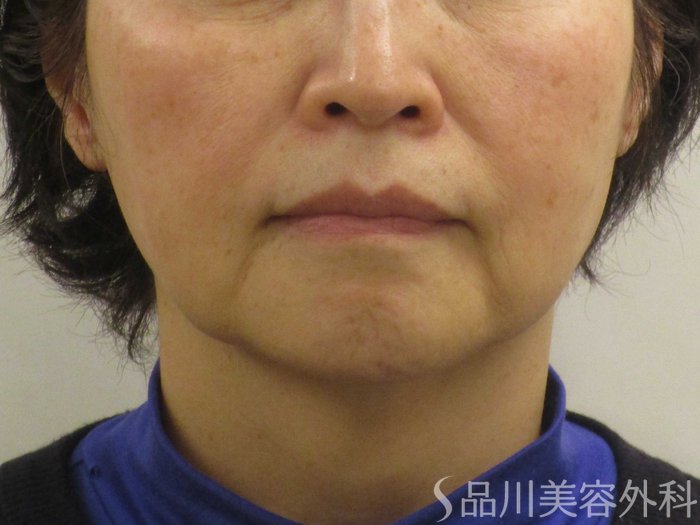 症例NO.74866のBEFORE写真