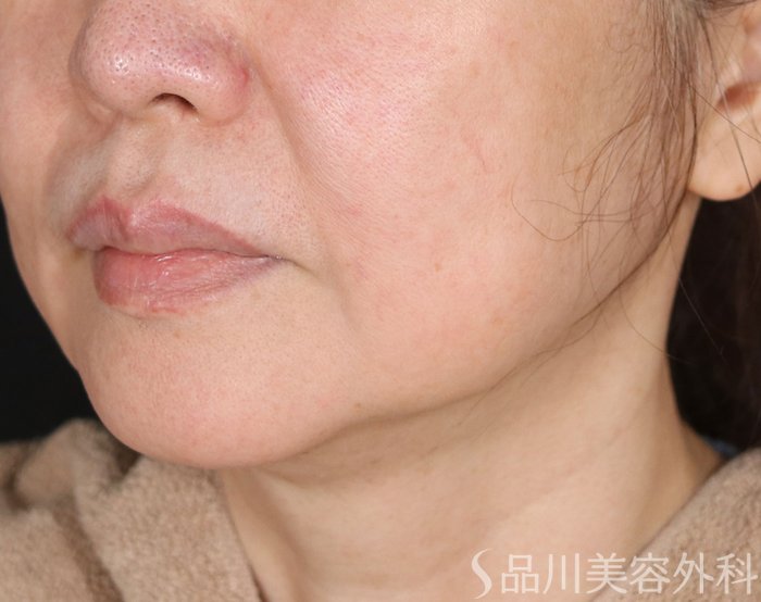 症例NO.72690のBEFORE写真