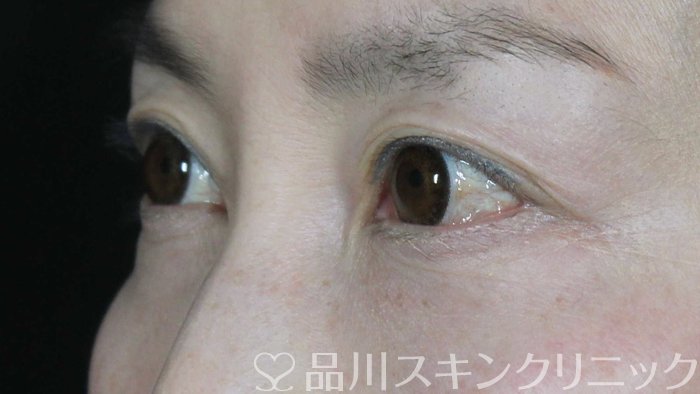 症例NO.69757のAFTER写真