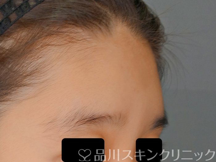 症例NO.70829のBEFORE写真