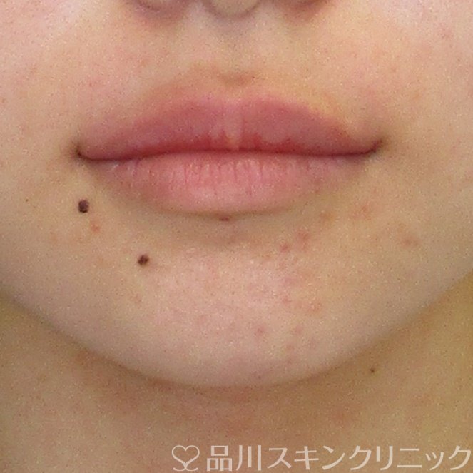 症例NO.69992のAFTER写真