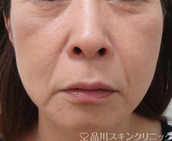 症例NO.30300のBEFORE写真