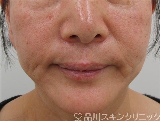 症例NO.41090のBEFORE写真
