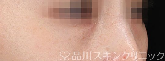 症例NO.75355のBEFORE写真