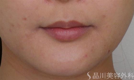 症例NO.48480のBEFORE写真