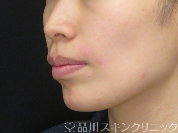 症例NO.70268のAFTER写真