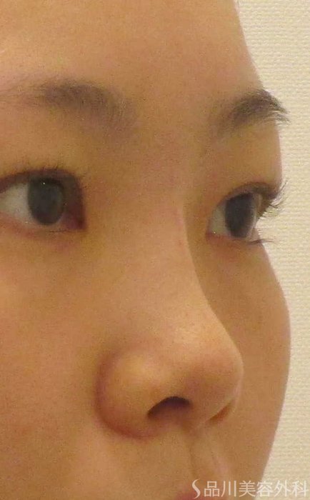 症例NO.65341のAFTER写真