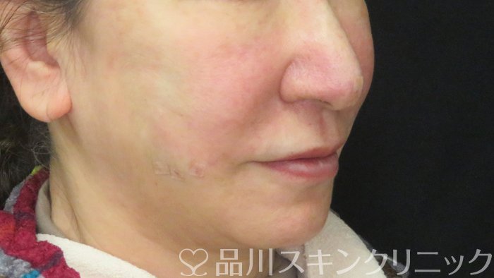 症例NO.71887のAFTER写真