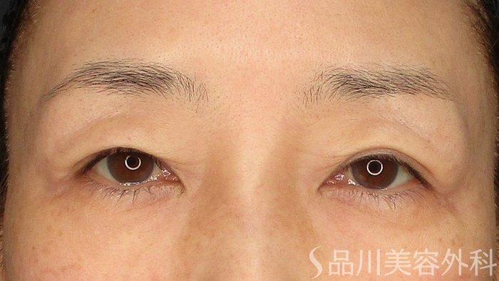 症例NO.72132のBEFORE写真