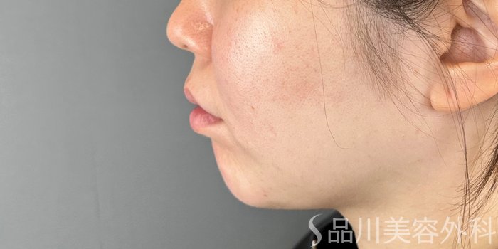 症例NO.73011のBEFORE写真