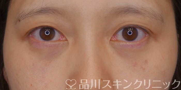 症例NO.73069のAFTER写真