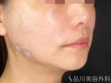 症例NO.73203のAFTER写真