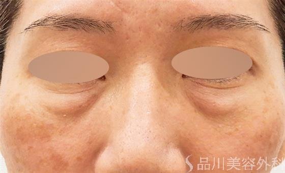 症例NO.61562のBEFORE写真