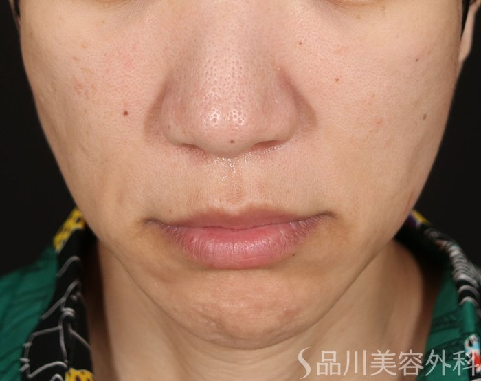 症例NO.71724のBEFORE写真