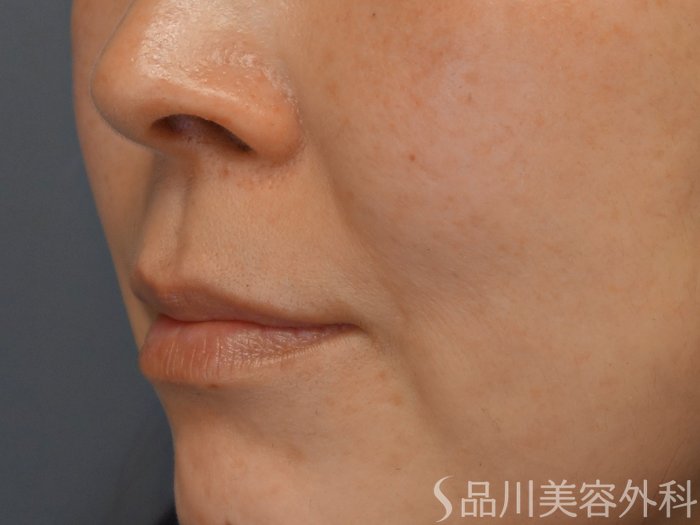 症例NO.69369のBEFORE写真