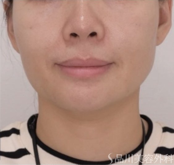 症例NO.71647のAFTER写真