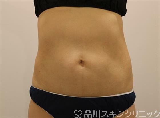 症例NO.43180のAFTER写真