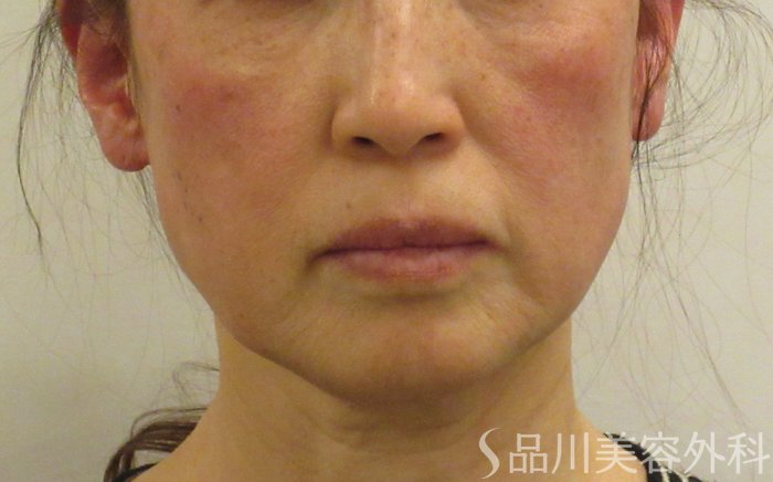 症例NO.68951のBEFORE写真