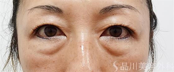 症例NO.61737のBEFORE写真