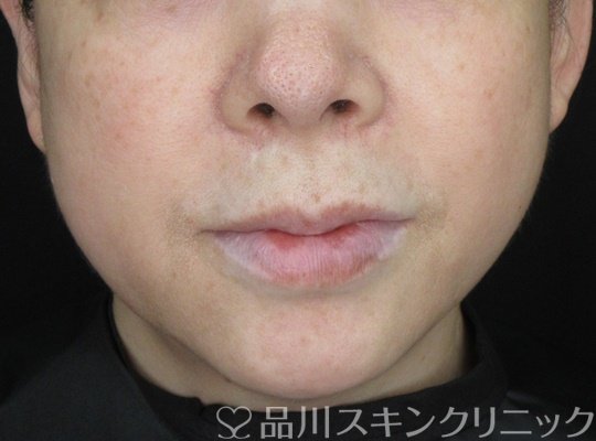 症例NO.70042のAFTER写真