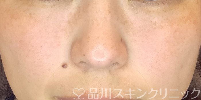 症例NO.69379のAFTER写真