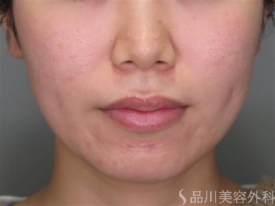 症例NO.46785のBEFORE写真