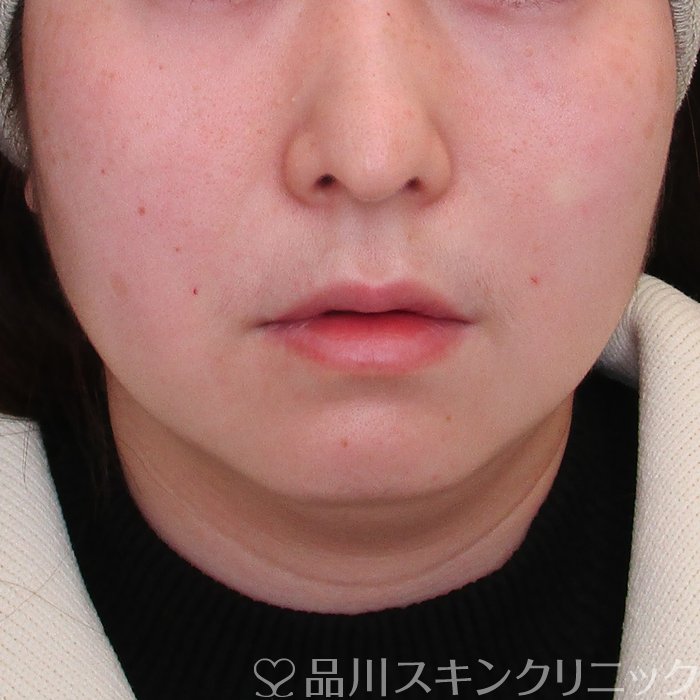 症例NO.73987のAFTER写真
