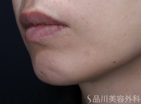 症例NO.73686のBEFORE写真