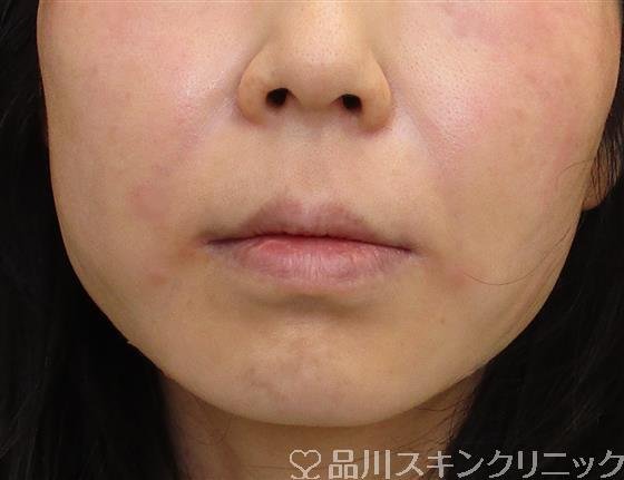 症例NO.59137のAFTER写真