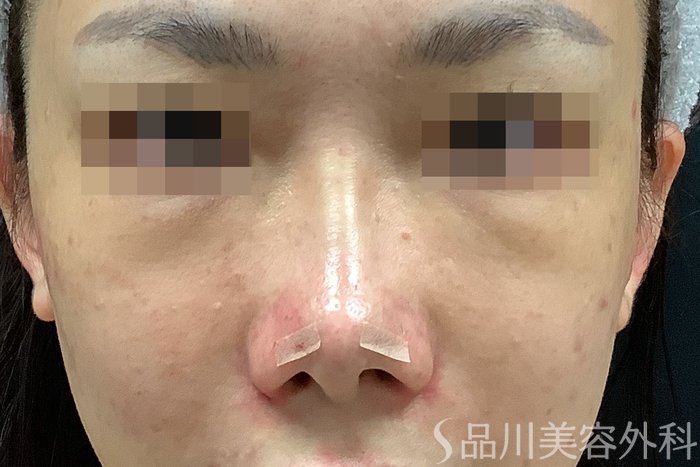 症例NO.71638のAFTER写真