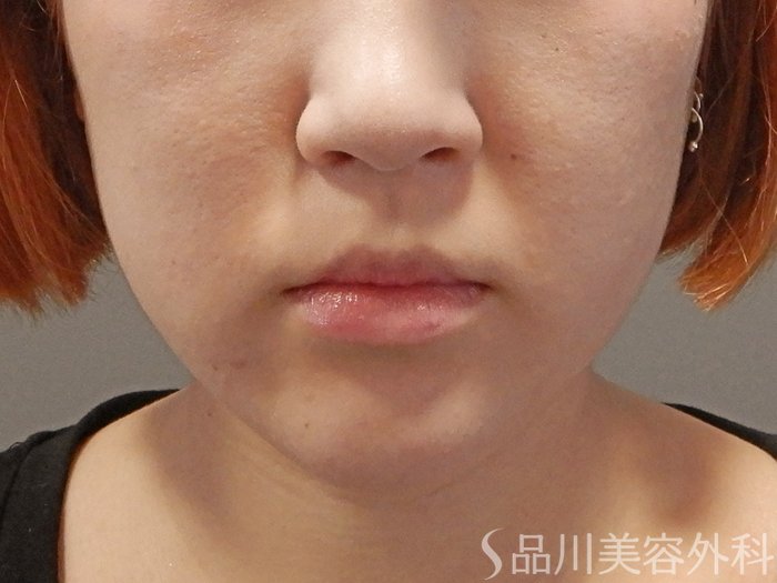 症例NO.71601のBEFORE写真