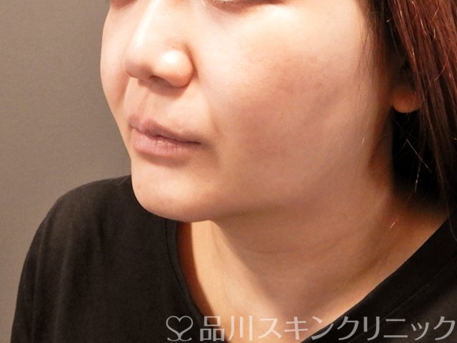 症例NO.69394のBEFORE写真