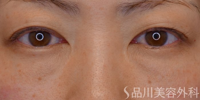 症例NO.72943のBEFORE写真