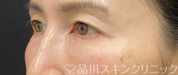 症例NO.74861のAFTER写真