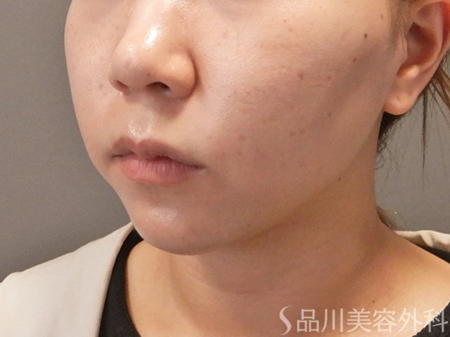 症例NO.74288のAFTER写真